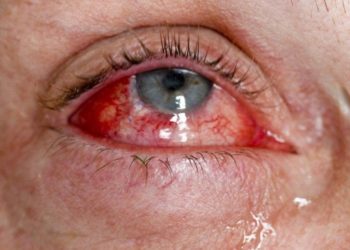 Bulaşıcı ‘kırmızı göz’ hastalığı hızla yayılıyor: Sayı 86 bini geçti